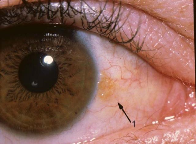 Ожог глаза: первая помощь и лечение
